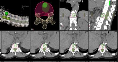 Clinical Evaluation of an Auto-Segmentation Tool for Spine SBRT Treatment